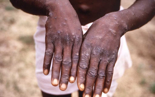 monkeypox-190522-01